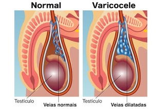 Illustration for article titled Obat Varikokel Paling Ampuh